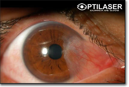 Clinica de ojos Optilaser - Carnosidad